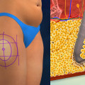 The Most Common Complications of Liposuction: An Expert's Perspective