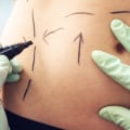 The Safest and Most Effective Liposuction Procedures