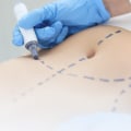 Understanding Swelling After Liposuction: What You Need to Know