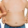 Losing Weight with Liposuction: An Expert's Perspective