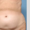 The Truth About Aggressive Liposuction: Insights from a Plastic Surgery Expert