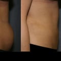 The Truth About Liposuction: Essential Insights and Considerations