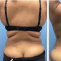 The Truth About Fat After Liposuction: Understanding Your Body's Changes