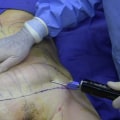 The Safe Limits of Fat Removal in Liposuction Procedures