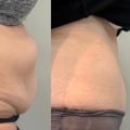 Understanding Weight Gain After Liposuction