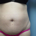 The Truth About Weight Gain After Liposuction