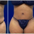Who Should Avoid Liposuction? A Surgeon's Perspective