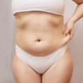 The Safe Limit for Liposuction: An Expert's Perspective