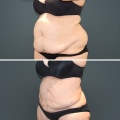 Is Liposuction Safe for Obese Patients?