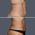 The Truth About Weight Gain After Liposuction