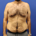 The Truth About Liposuction: Can You Really Remove 100 Pounds?