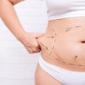 Is Liposuction Suitable for Thin People? Understanding the Myths and Realities