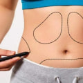 The Truth About Liposuction: Permanently Removing Belly Fat