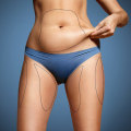 The Truth About Liposuction: Is It a Permanent Solution?