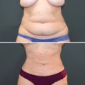 The Recovery Process After Liposuction: What to Expect