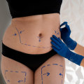 The Truth About Liposuction: Understanding Its Role in Weight Loss and Body Contouring