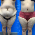 The Truth About Losing Weight After Liposuction