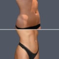 The Truth About Multiple Liposuction Procedures: What You Need to Know