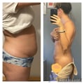 The Truth About Liposuction: What You Need to Know Before Getting Lipo Again