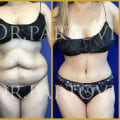 The Truth About Liposuction: Understanding Realistic Weight Loss Expectations