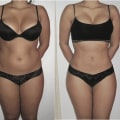 The Truth About Liposuction: How to Achieve and Maintain Long-Lasting Results