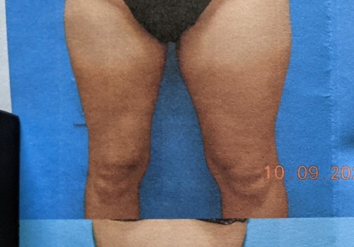 How to Achieve a Slimmer Waist with Liposuction