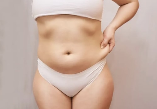 Can a 200 pound woman get liposuction?
