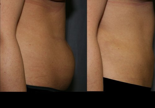 The Truth About Liposuction: Risks and Benefits