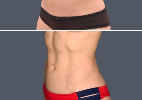 Is Laser Liposuction Right for You?