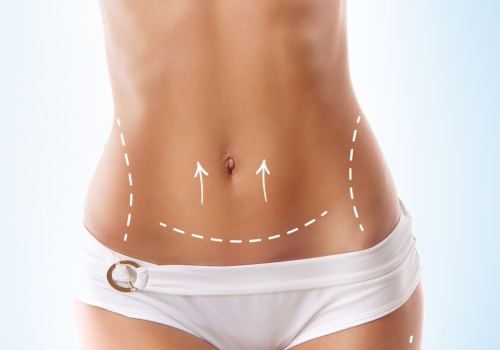 The Pros and Cons of Liposuction: An Expert's Perspective
