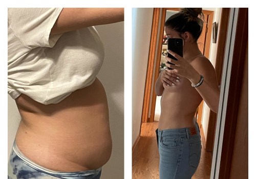 The Truth About Liposuction Regret