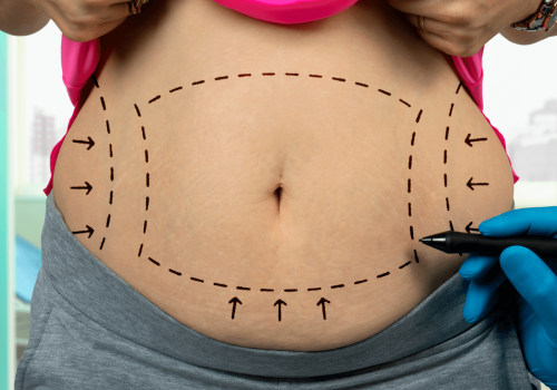 The Truth About Liposuction: Is it Really Permanent?
