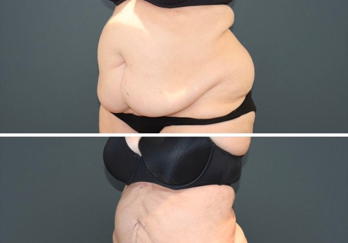 The Truth About Liposuction Complications