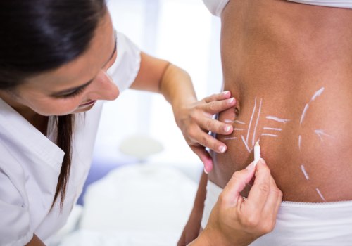 The Transformative Power of Liposuction