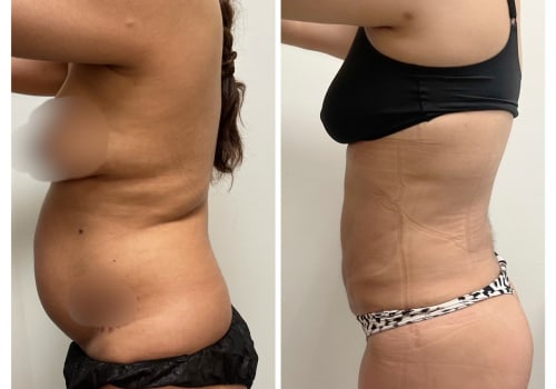 Can you get lipo if you're skinny?