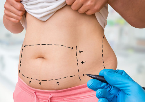 The Truth About Liposuction: Is it Really Permanent Fat Loss?