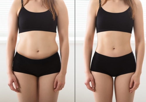Is Laser Liposuction Right for You?