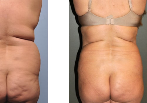 Is it harder to gain weight back after lipo?