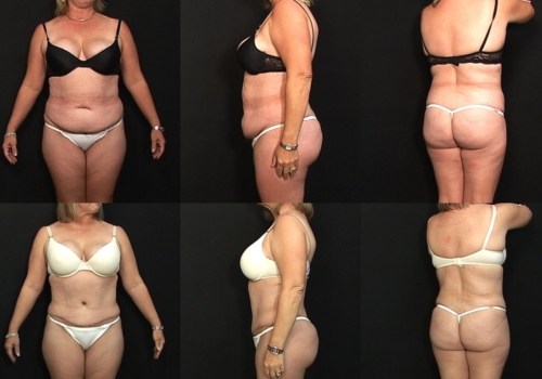 Can i have liposuction if i'm overweight?