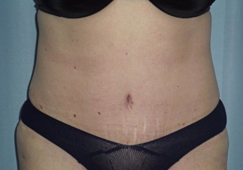 The Truth About Weight Gain After Liposuction