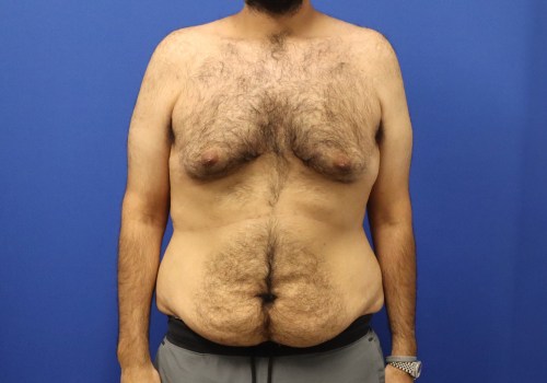 The Truth About Liposuction: Can It Really Remove 100 Pounds?