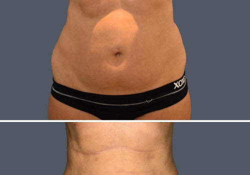 Who Should Avoid Liposuction?