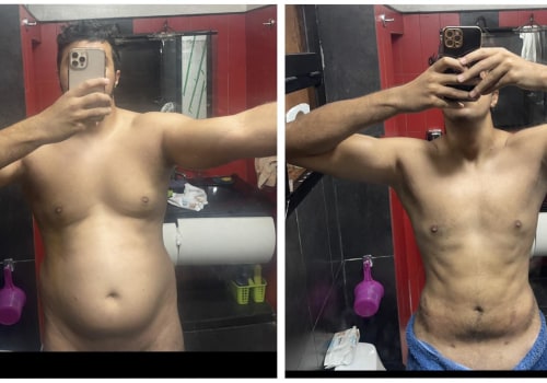 The Truth About Liposuction: What You Need to Know