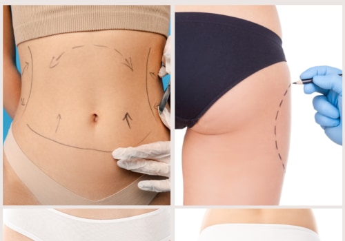The Truth About Liposuction: Separating Fact from Fiction