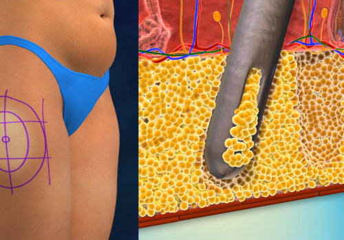 The Truth About Liposuction: An Expert's Perspective