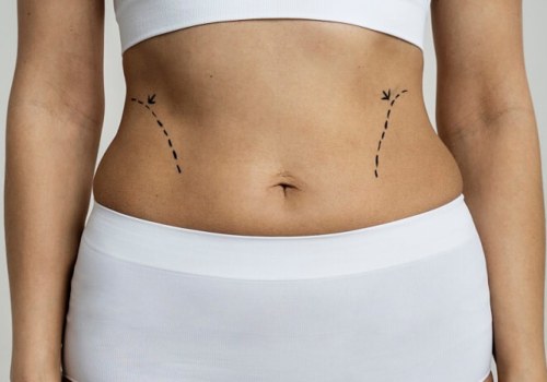 The Truth About Fat and Liposuction: Will It Ever Come Back?