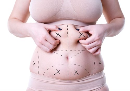 Is Liposuction Right for You?