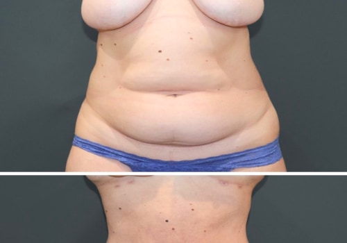 The Long-Lasting Effects of Liposuction: What You Need to Know