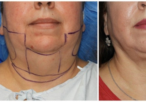 The Best Age for Liposuction: An Expert's Perspective