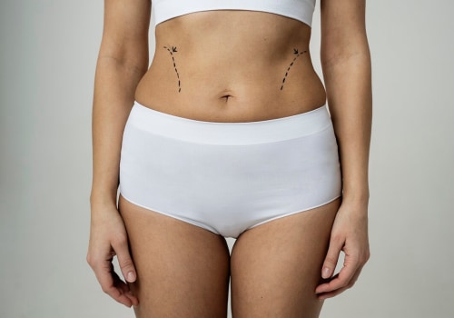 The Truth About Liposuction: Does Fat Stay Off?
